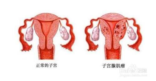子宫腺肌症最新治疗方法，变化带来自信与成就感的秘诀